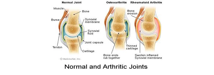 Chiropractic patients have fewer strokes than the rest of the population